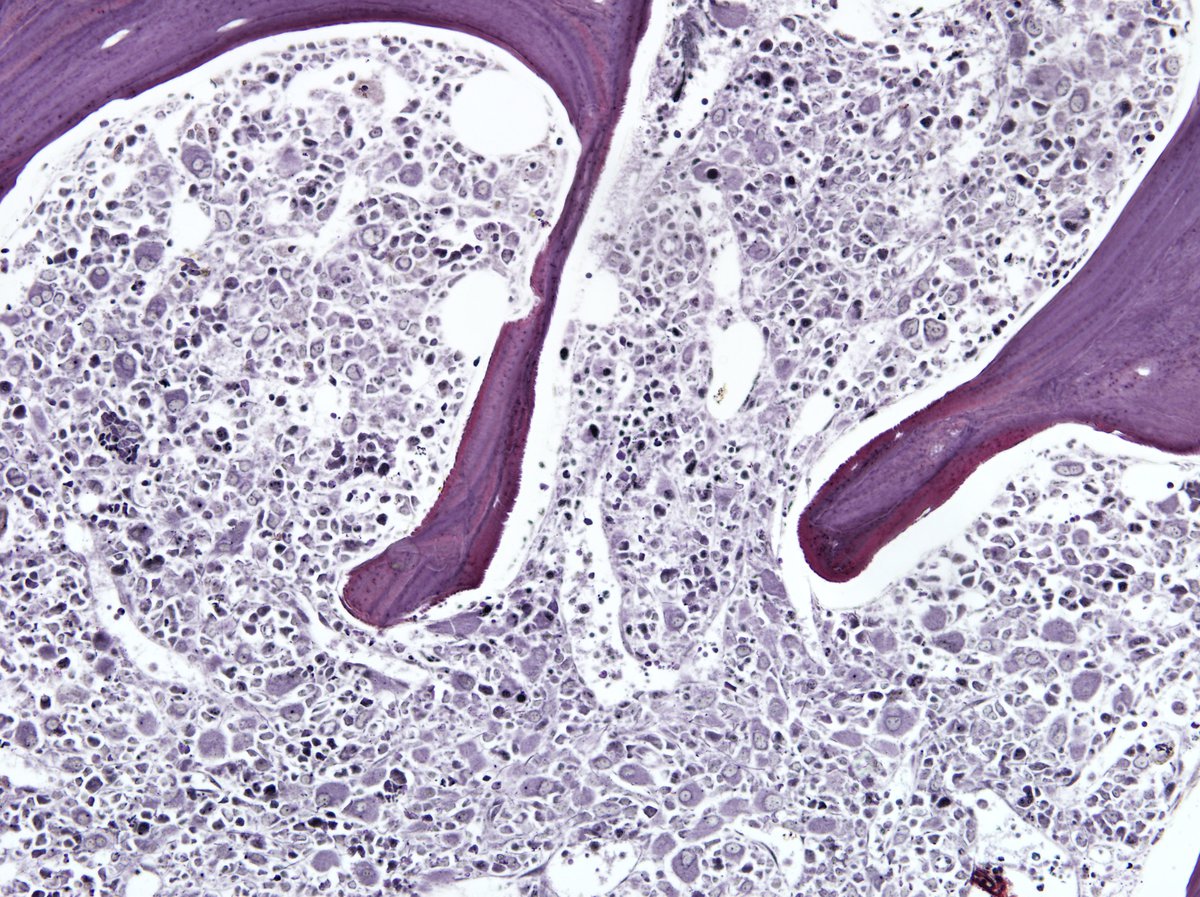 Patient’s first marrow biopsy (1998, not submitted): Reticulin stain showed mild reticulin fibrosis (1+). 